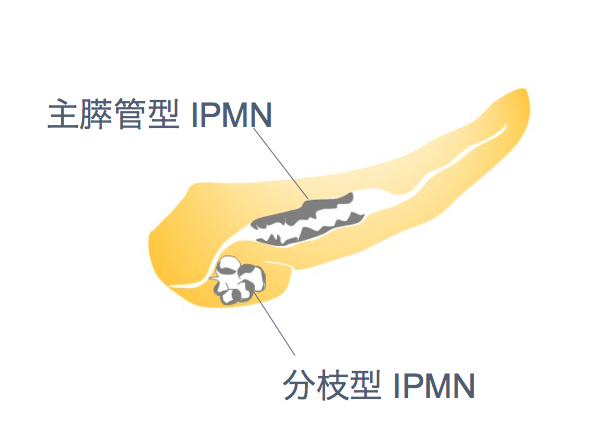 観察 ipmn 経過 IPMNについてお聞きします。