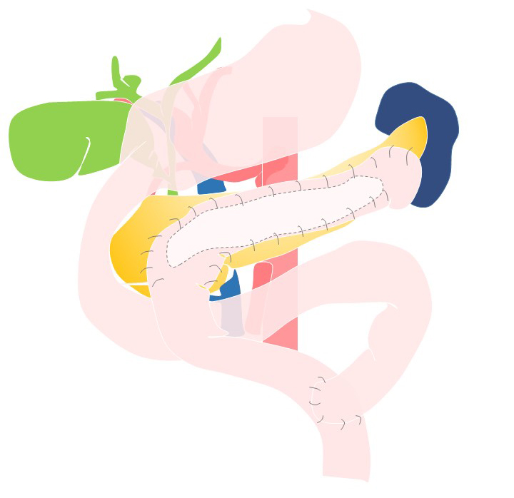 膵ドレナージ手術　膵管空腸側々吻合術